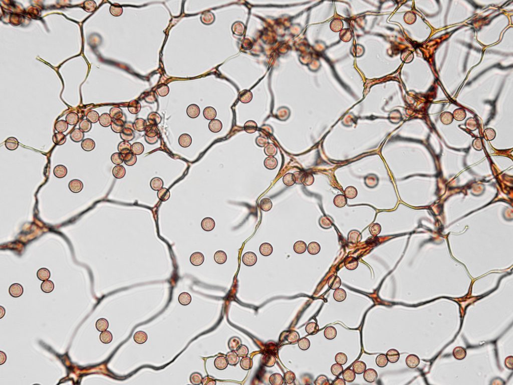 Chronic CIRS From Mold – Symptoms and Functional Medicine Recovery